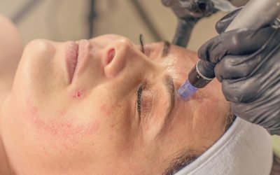 Embrace Microneedling to Age Beautifully